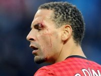 Ferdinand é atingido no rosto, sai sangrando e ainda brinca