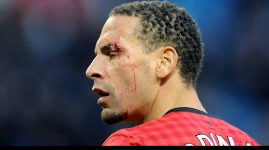 Imagem Ferdinand é atingido no rosto, sai sangrando e ainda brinca
