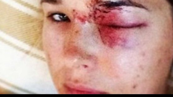 Imagem Musa do vôlei toma bolada do próprio marido no rosto