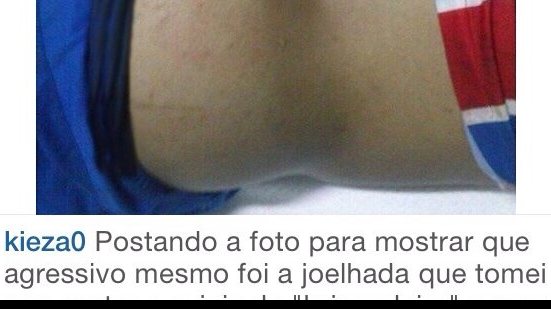 Imagem Após joelhada de ex-Vitória e com hematoma nas costas, Kieza critica juiz