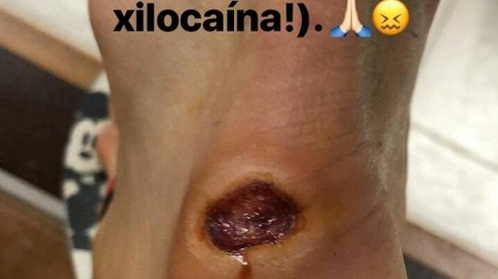 Imagem Será que incomoda? Veja a imagem do calo no pé do volante Fillipe Soutto